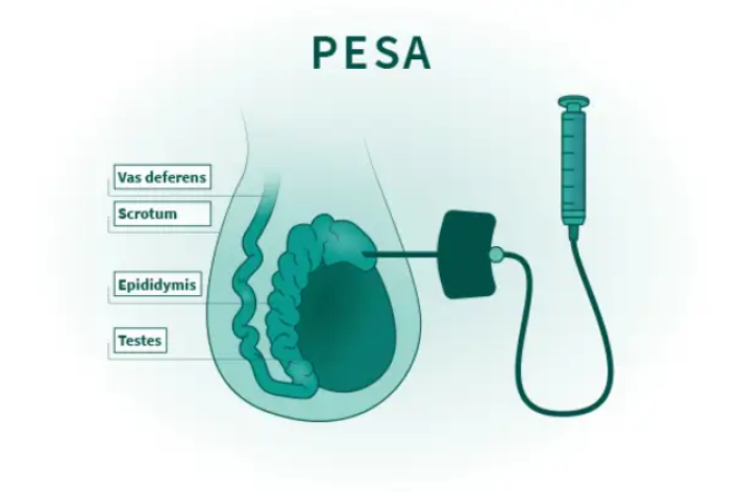 Picture1(77) Diagram of PESA: cross-section of the scrotum showing testes, epididymis, vas deferens, with a needle used to retrieve sperm via epididymal aspiration.