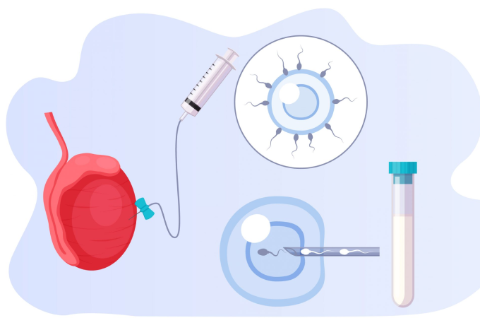 Picture1(78) IVF laboratory illustration showing an egg being inseminated with a syringe under a microscope, with a test tube nearby.